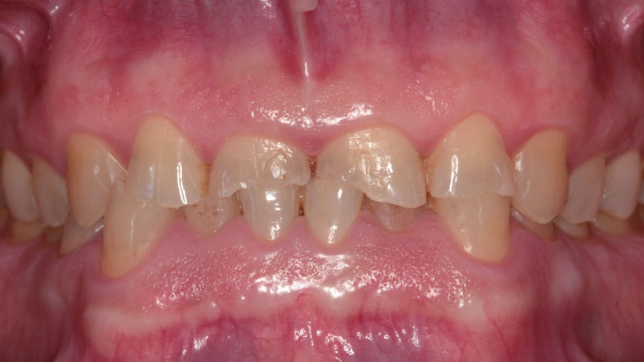 Abb. 4 Ausgangssituation: Erheblich abradierte Zähne im OK und UK.