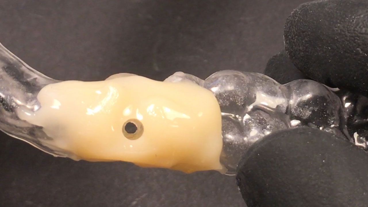 Abb. 8 Die umgearbeitete Implantat-Bohrschablone trägt den Schraubenkanal. Damit kann die Abutmentschraube erreicht und eine Schraubenlockerung bei Be-darf behoben werden. Quelle: Libecki