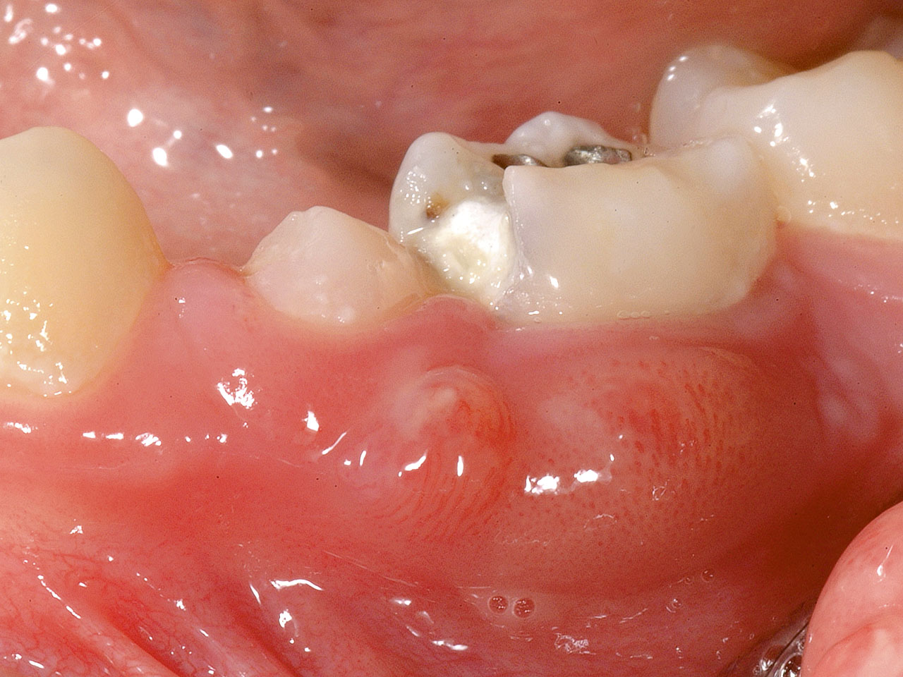 Abb. 3 Das Bild zeigt einen submukösen Abszess ausgehend von Zahn 74 bei dem 8-jährigen Patienten. Eine extraorale Symptomatik lag nicht vor. Das therapeutische Vorgehen der Wahl war die Extraktion.