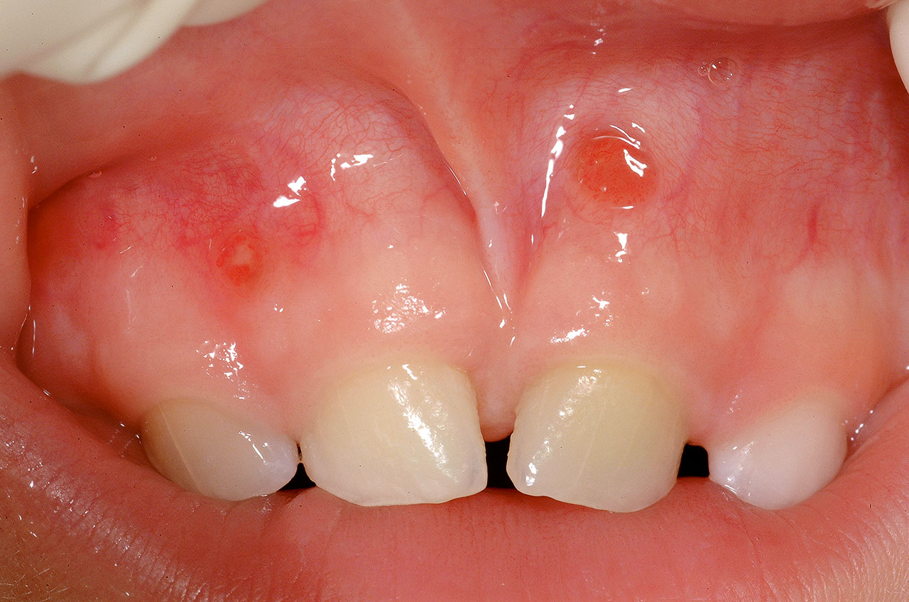 Abb. 4 Typisches klinisches Bild einer chronisch apikalen Parodontitis mit Fistelbildung an den Zähnen 51 und 61. Als Ursache lag hier ein zurückliegendes Unfallereignis vor. Das therapeutische Vorgehen der Wahl war die Extraktion der beiden Milchfrontzähne.