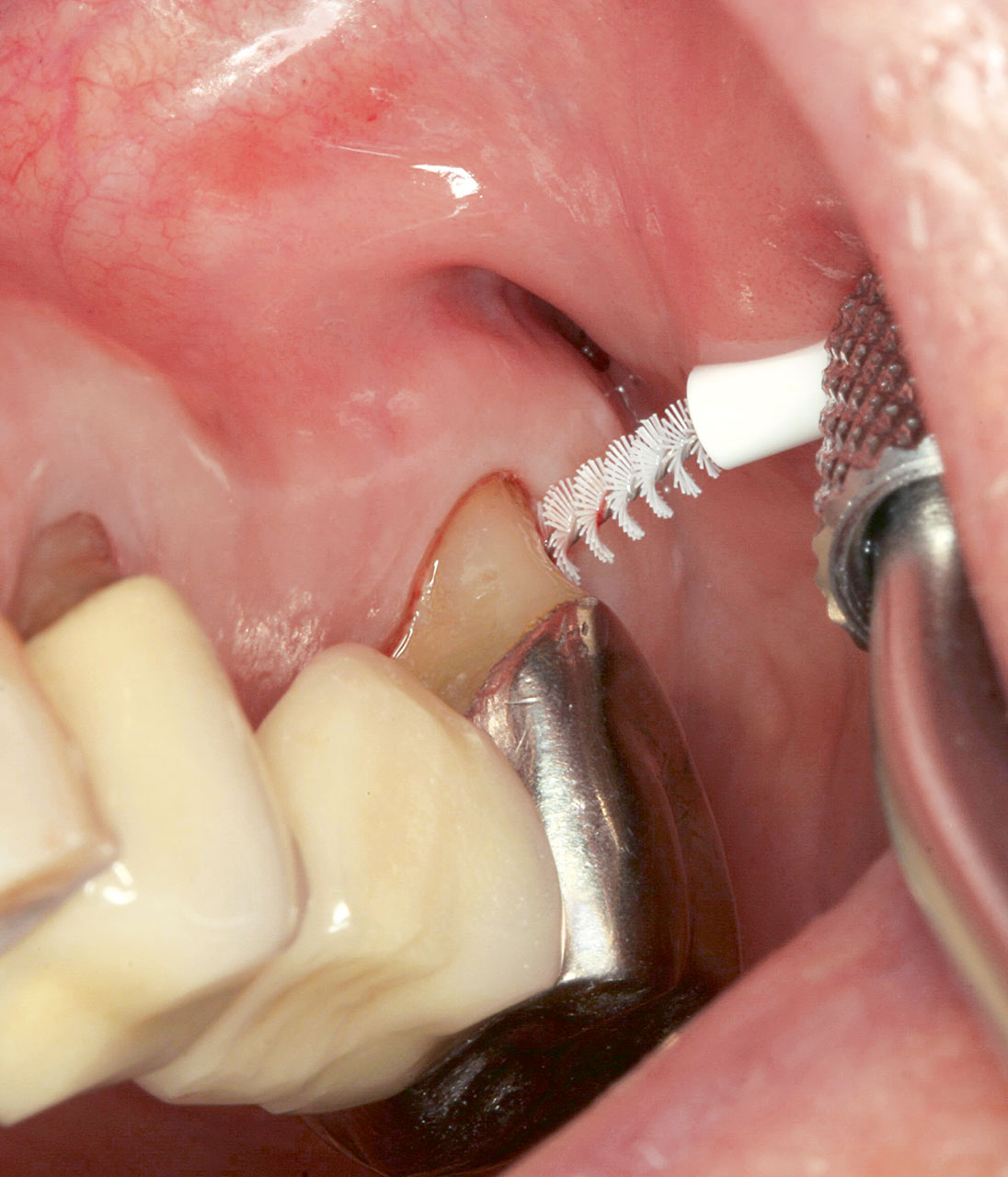 Abb. 8 ... die Furkation an Zahn 27 ist zumindest teilweise für die individuelle Plaquekontrolle zugänglich ...