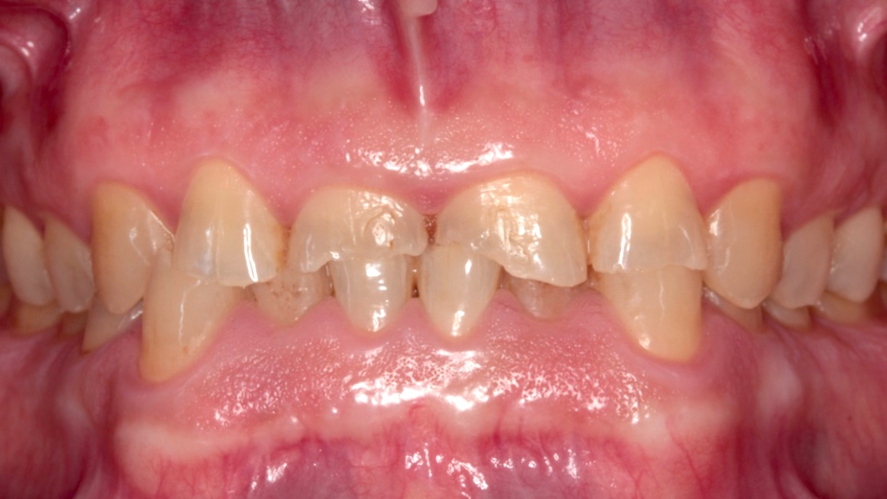 Abb. 5: Ausgangssituation: Erheblich abradierte Zähne im OK und UK. (Foto: Türp/Chaar)