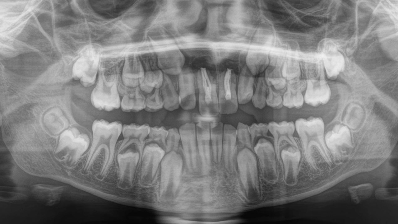 Abb. 2 Röntgenübersichtsaufnahme: Zustand nach Replantation und endodontischer Versorgung bei abgeschlossener erster Wechselgebissphase.