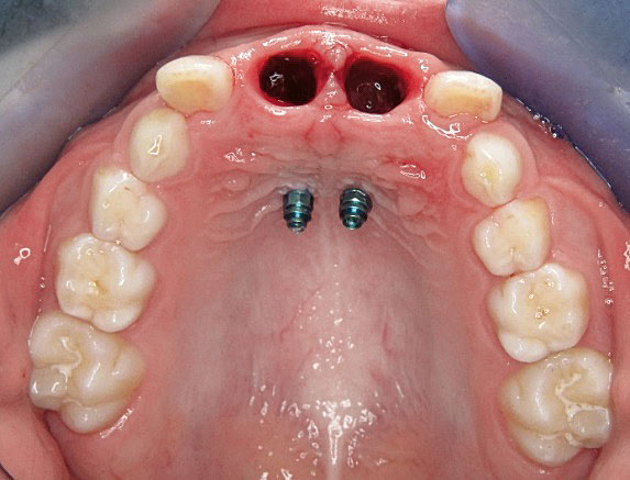 Abb. 6 Paramediane Insertion zweiter orthodontischer Miniimplantate (Ortho-Easy pal, Forestadent) ...
