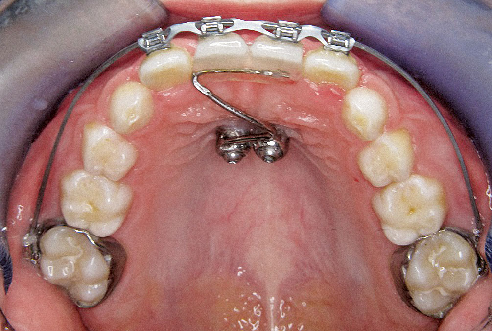 Abb. 8 Aktive kieferorthopädische Therapie in der zweiten Wechselgebiss­phase. Die durch ortho­dontische Miniimplantate verankerten „Ersatzzähne“ wurden mit Brackets versehen und als Verankerungseinheit genutzt.