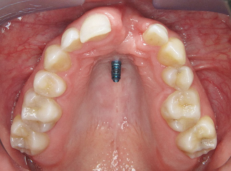 Abb. 12 Intraoraler Aspekt: mediane Insertion zweier orthodontischer Miniimplantate (Ortho-Easy pal) ...