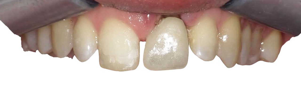 Abb. 14 Vestibuläre Ansicht des miniimplantatverankerten Zahns.