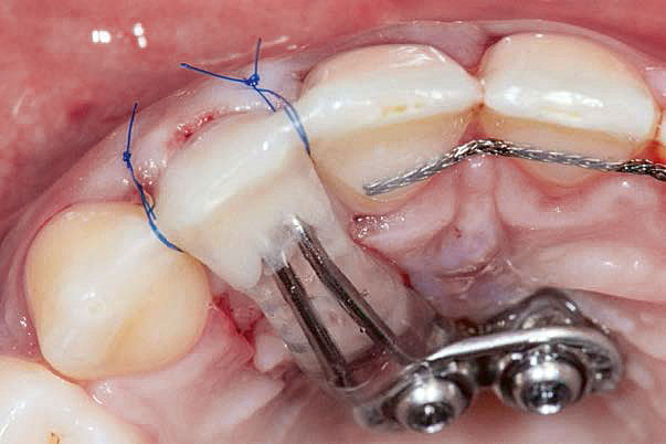 Abb. 18 „Cantilever-Brücke“, auf orthodontischen Miniimplantaten verankert. Diese kann einfach entfernt und wieder eingesetzt und über die Jahre verändert werden.