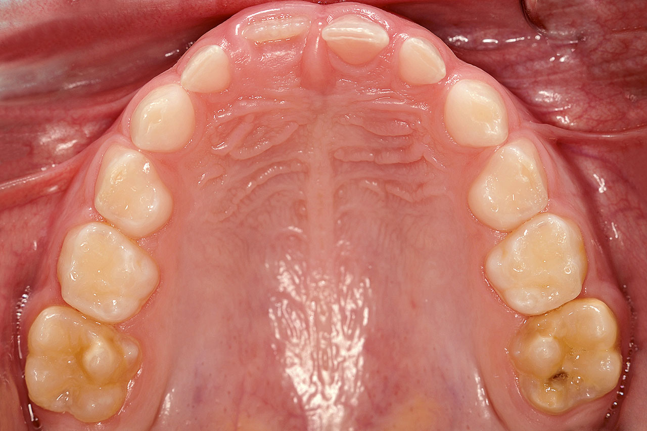 Abb. 1 Oberkiefer mit deutlich ausgeprägter MIH bei den Zähnen 16 und 26.