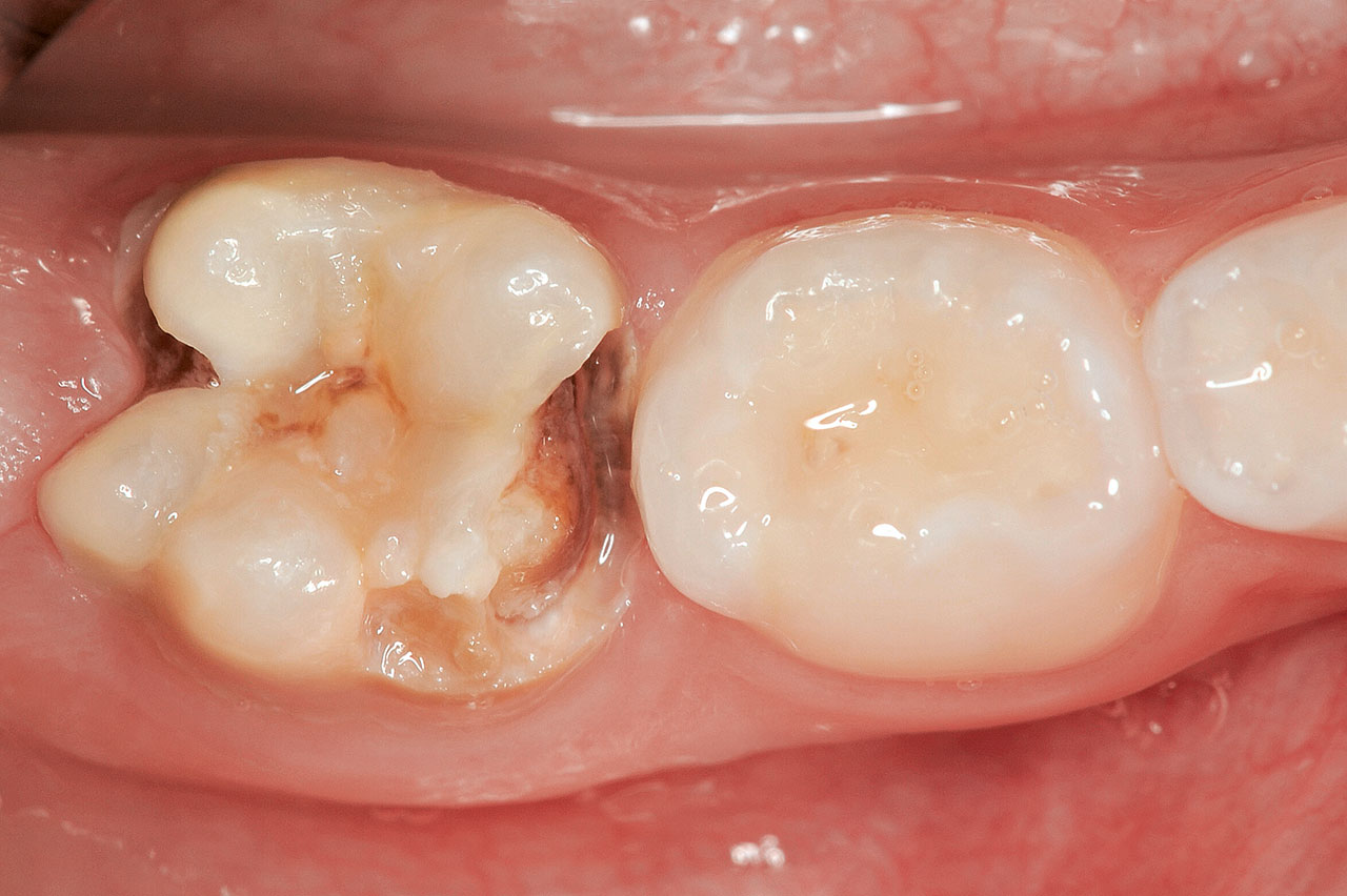 Abb. 3 Zahn 46 vor der Behandlung: MIH und Karies mesial und distal.