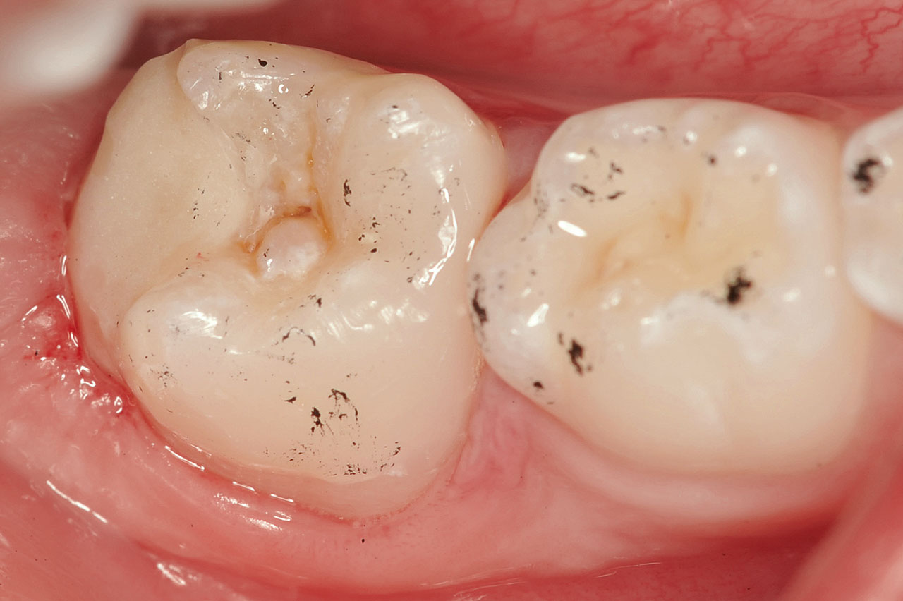 Abb. 7 Okklusionskontrolle nach Legen einer distalen Glasionomerzementfüllung an Zahn 46. Mesial war der Zahn bereits mit einer adhäsiven Füllung versorgt worden.