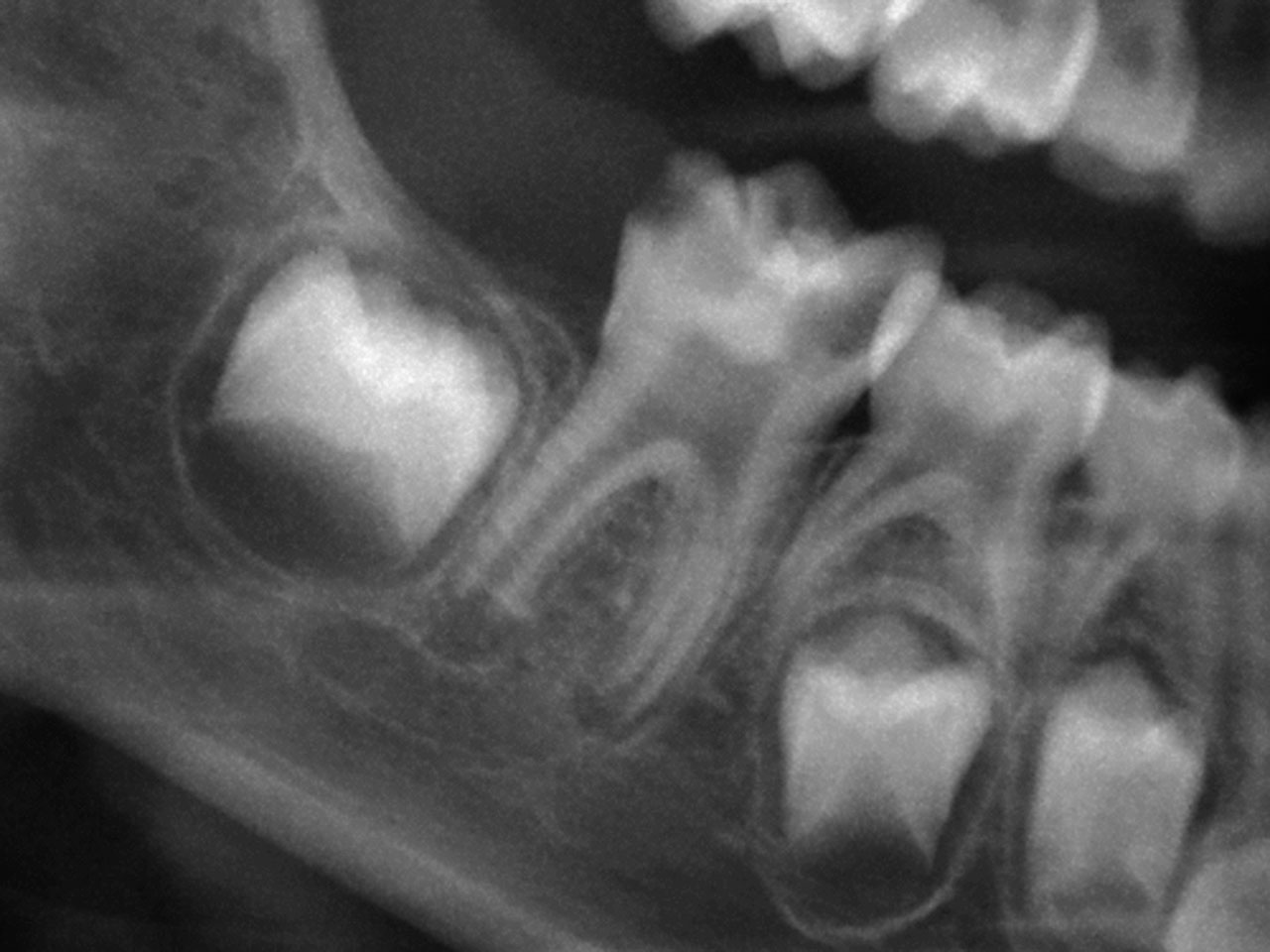 Abb. 8 Röntgenbild vor der Behandlung: Zahn 46 zeigt mesial und distal tiefe kariöse Läsionen.