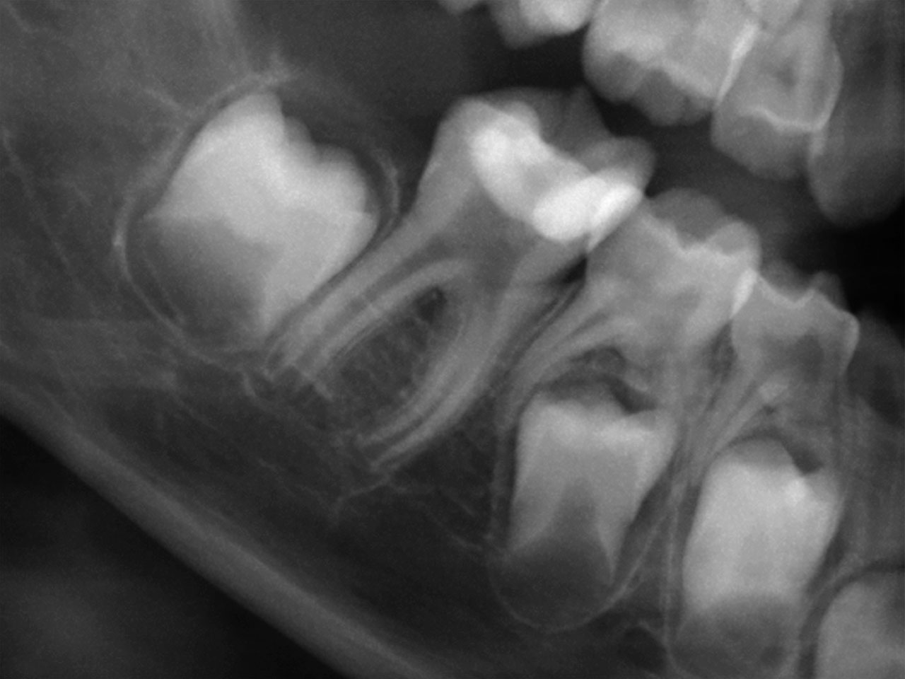 Abb. 9 Röntgenbild 12 Monate nach der Behandlung: An Zahn 46 ist kein apikaler Prozess, jedoch ein fortgeschrittenes Wurzelwachstum und eine suffiziente restaurative Versorgung zu erkennen.
