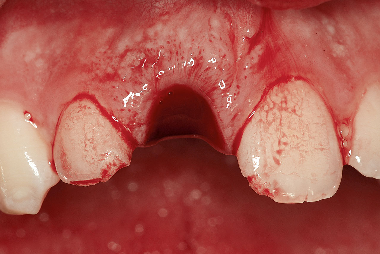 Abb. 10 Zustand direkt nach Avulsion von Zahn 11 im Jahr 2015.