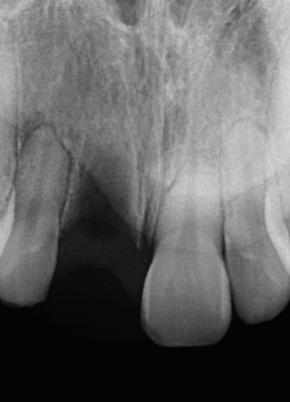 Abb. 11 Röntgenaufnahme nach Avulsion des Zahnes 11.