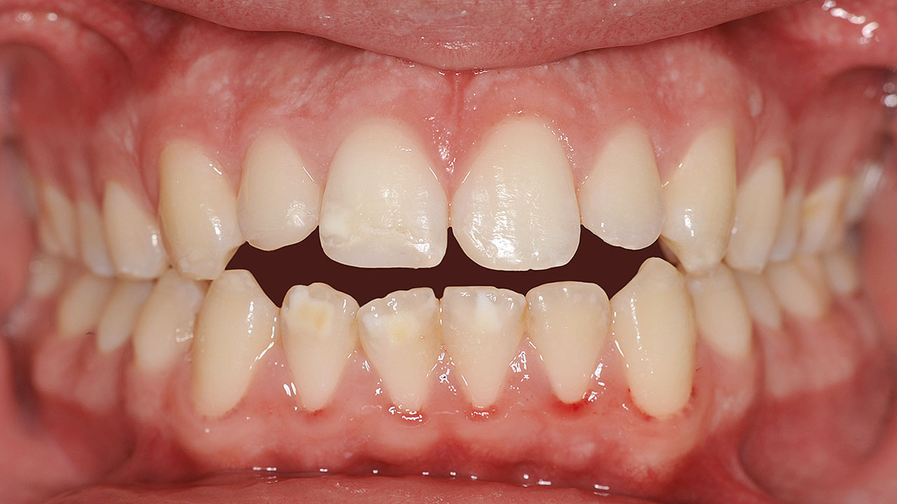 Abb. 17 Bei der Nachkontrolle nach 18 Monaten war der Zahn 11 in situ und vollständig beschwerdefrei.