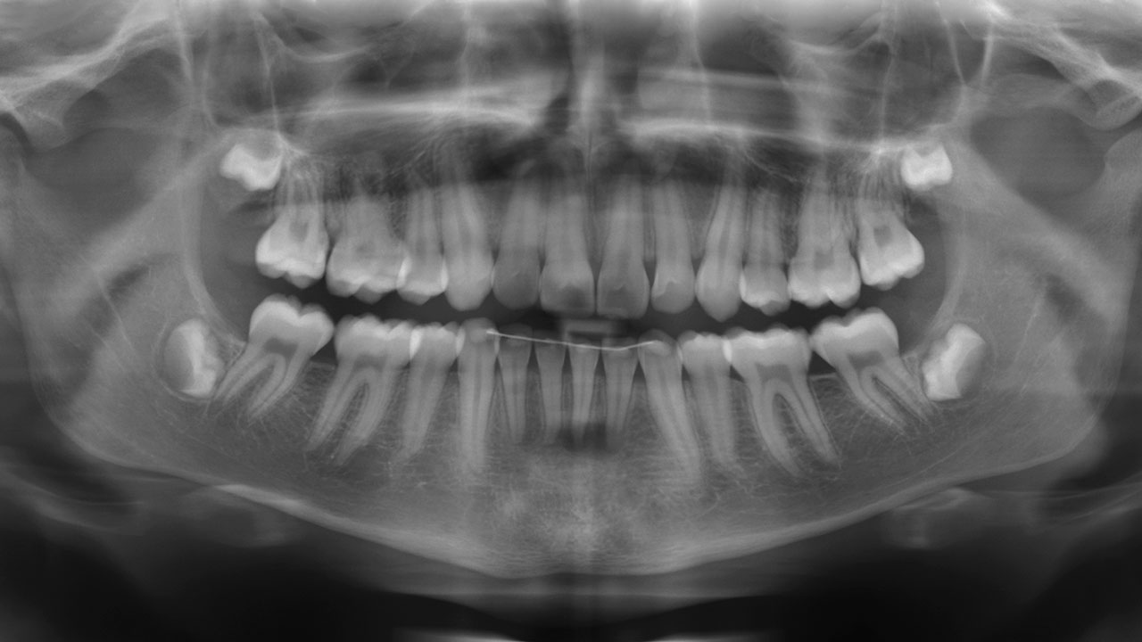 Abb. 18 Panoramaschichtaufnahme mit zystischer Veränderung im Bereich der Wurzelspitzen der avitalen Zähne 41 und 31.