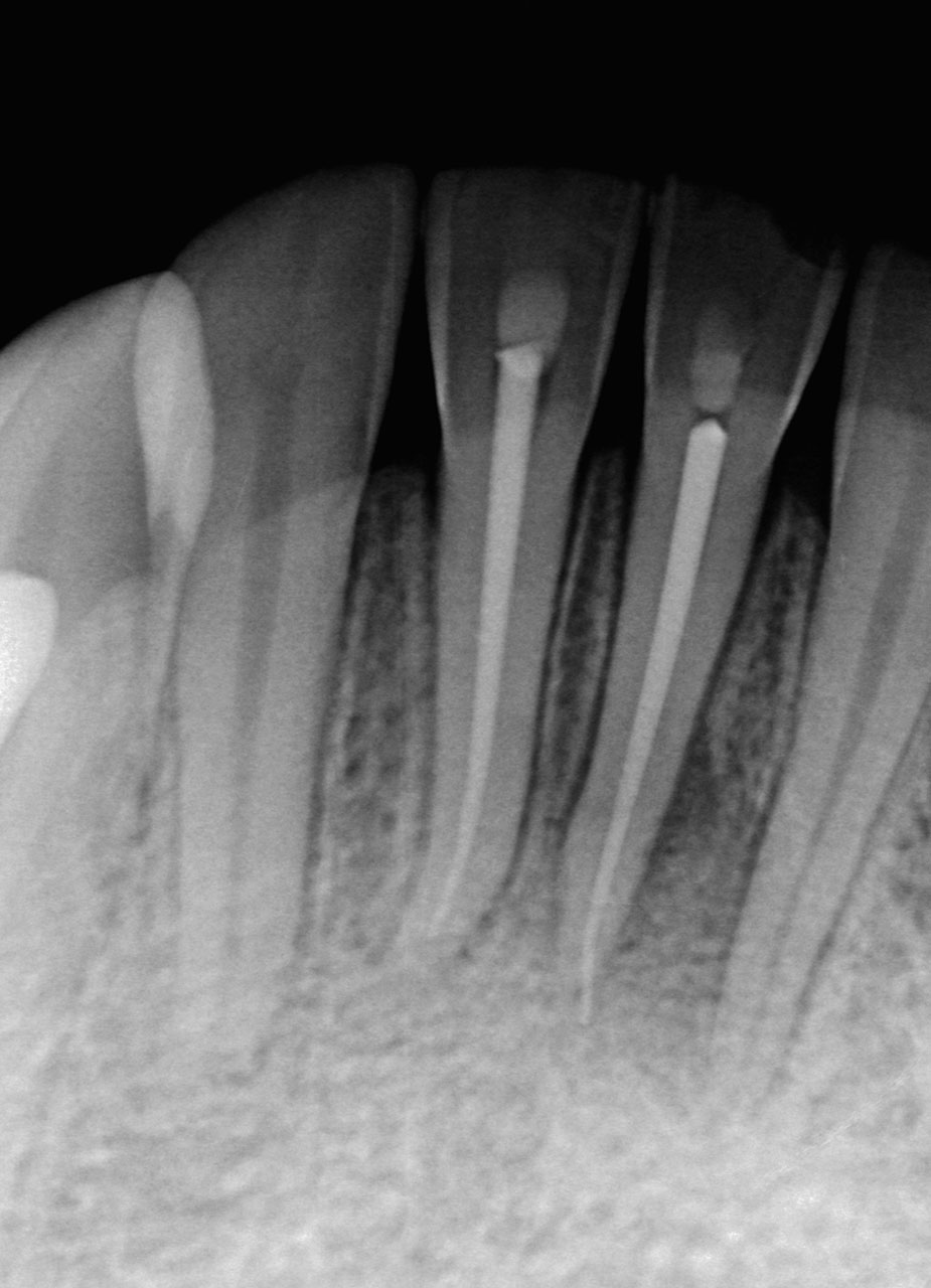 Abb. 19 Röntgenkontrollaufnahme nach Wurzelkanal­füllung mit BioRoot RCS an den Zähnen 41 und 31.