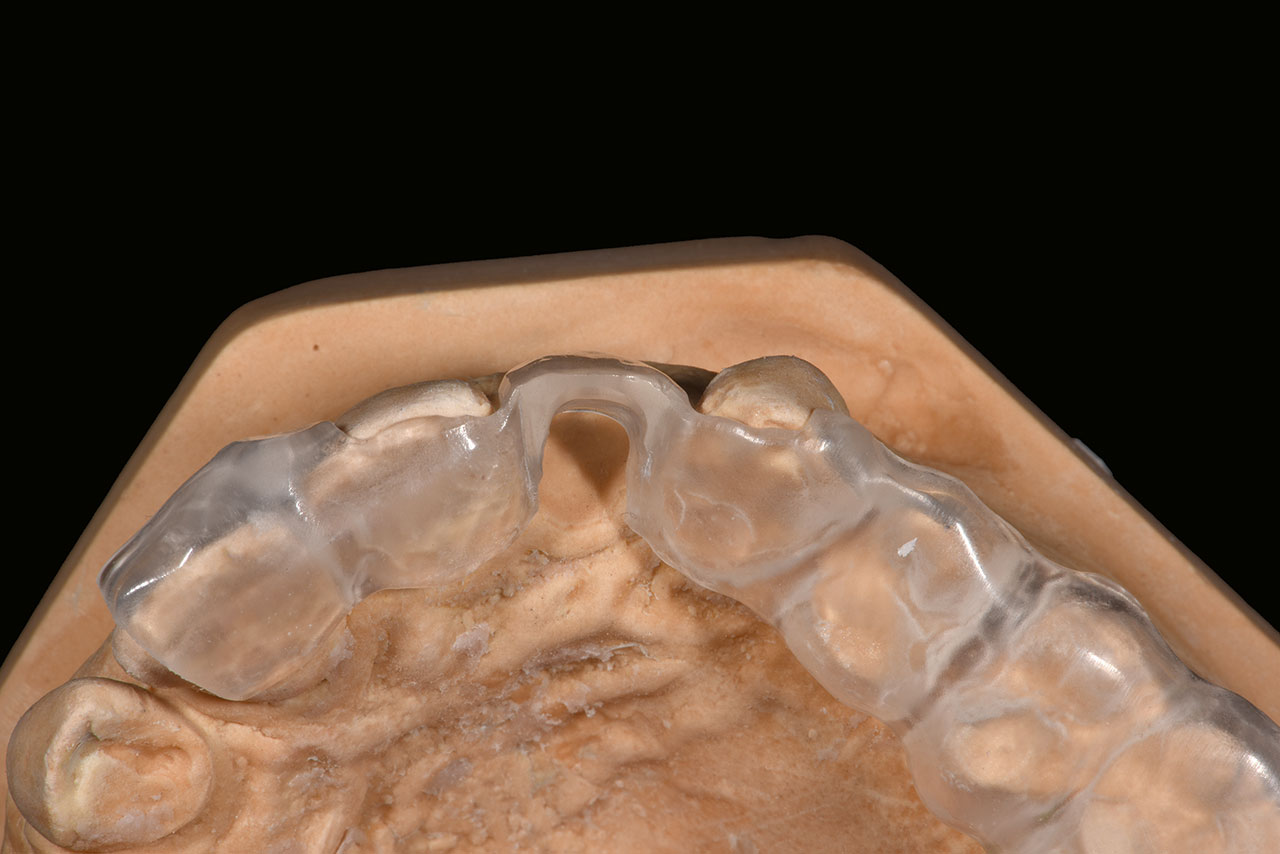 Abb. 2 Überführen des Wax-ups in transparentes PMMA, um die Zahnkonturen beim Eingriff zu visualisieren.