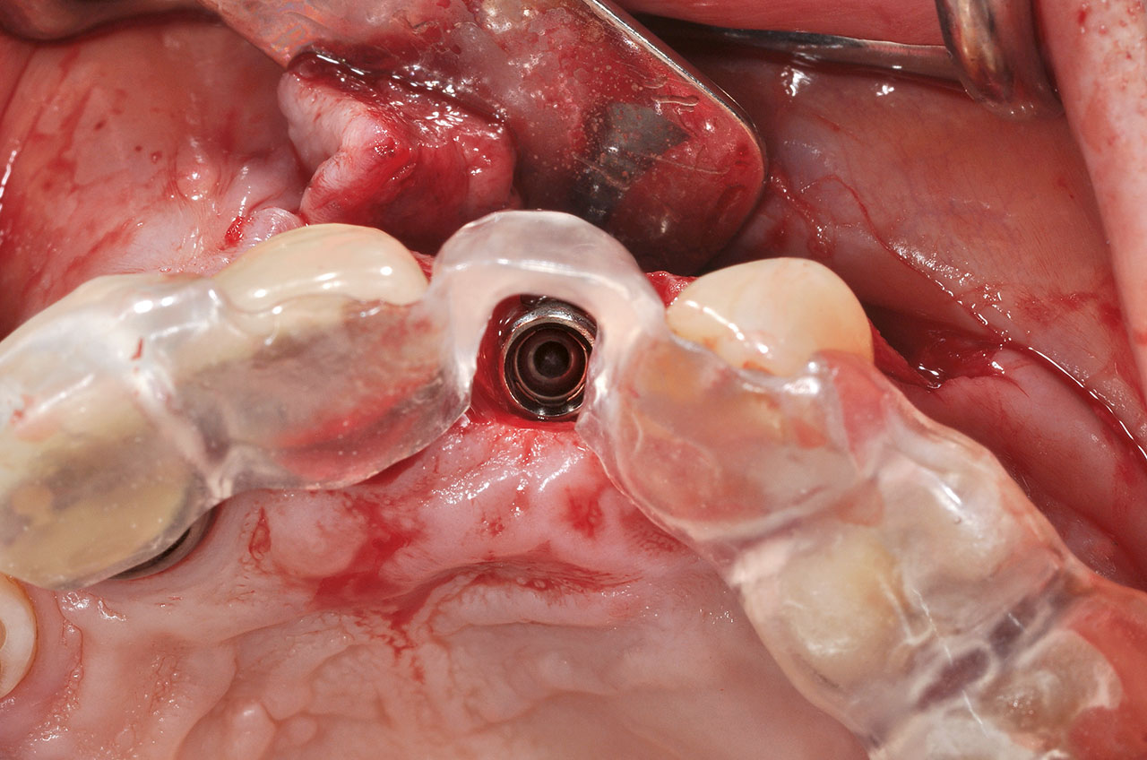 Abb. 3 Einbringen des Implantats und abschließende Achsen- und Tiefenkontrolle mithilfe der Implantatschiene.