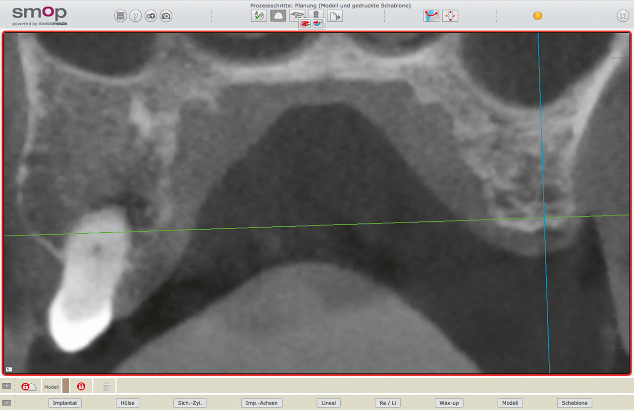 Abb. 5 DVT-Aufnahme mit sichtbarer Oberfläche des Gaumens.