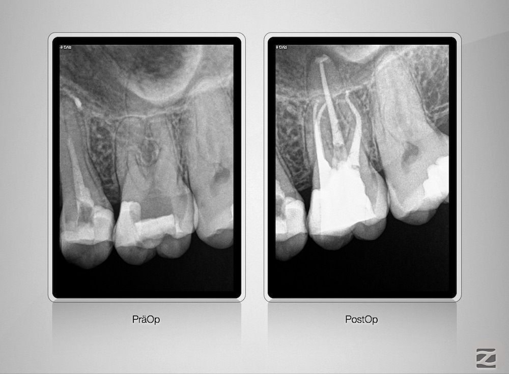 Röntgendokumentation der Ausgangssituation (links) und nach endodontischer Behandlung (Foto Schröder)