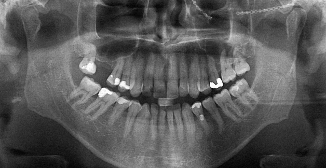 Abb. 2 46-jähriger, asymptomatischer Patient vor geplanter Implantattherapie im rechten Oberkiefer (Einzellücke Regio 16). Auf der Panoramaschichtaufnahme ist der Zustand der rechten Kieferhöhle nicht klar zu erkennen.