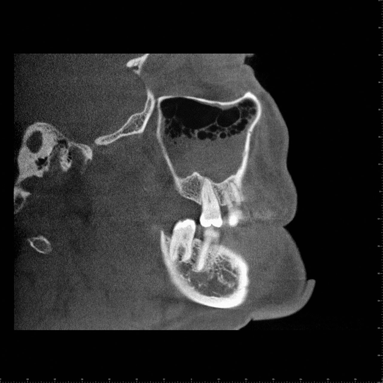 Abb. 12 bis 15: 45-jährige Patientin mit einer beidseitigen (rhinogenen) Sinusitis. In den DVT-Schnittbildern lassen sich in der linken Kieferhöhle eine Spiegelbildung (Luft-Flüssigkeitsspiegel) und rechts Luftblasen erkennen (sagittaler Schnitt der rechten Kieferhöhle; ...