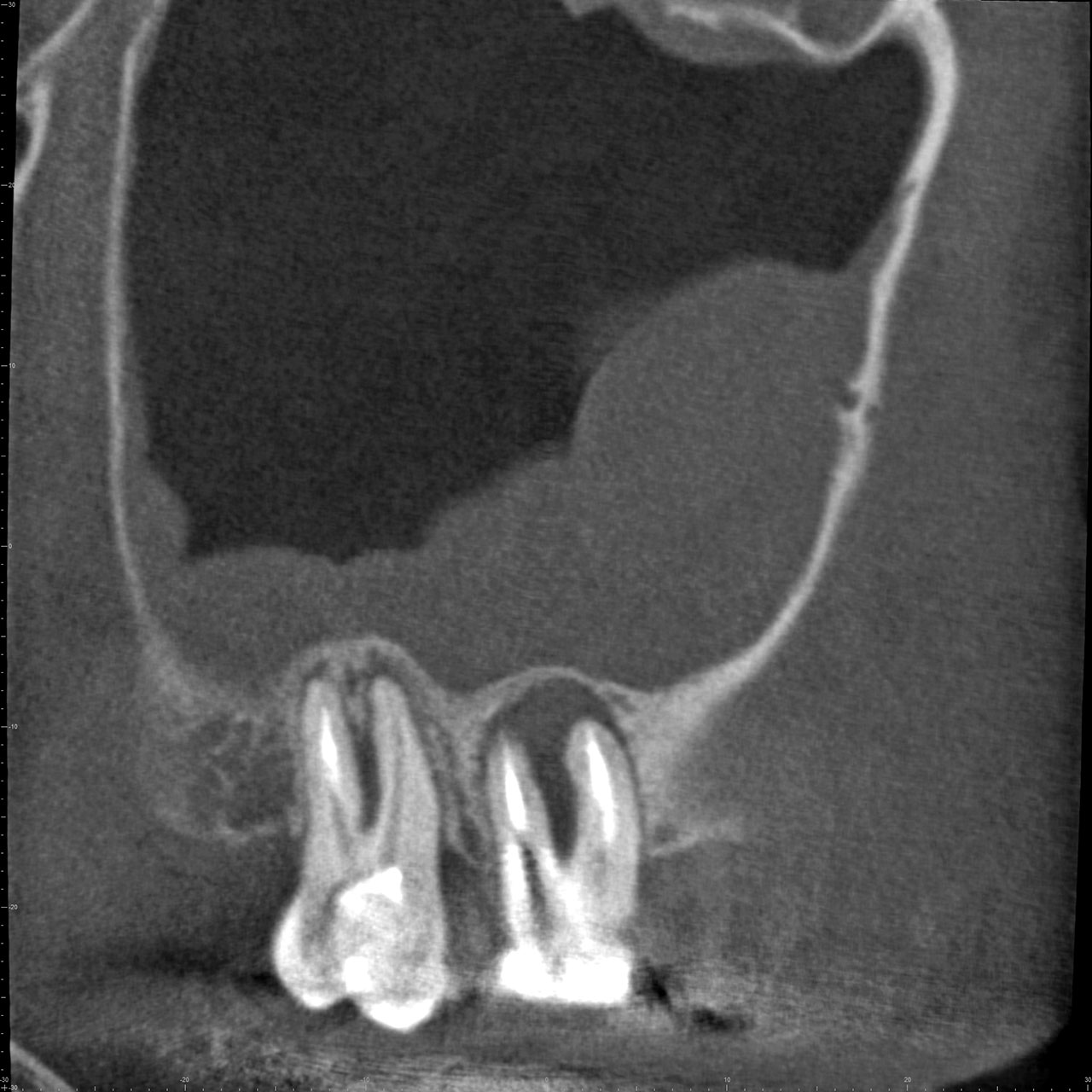 Abb. 18 46-jähriger Patient mit Verdacht auf eine odontogene Sinusitis in der rechten Kieferhöhle, die vermutlich durch apikale Pathologien an den Zähnen 16 und 17 verursacht wurde. Die Schneider‘sche Membran im rechten Sinus maxillaris ist basal über den befallenen Zahnwurzeln deutlich verdickt (sagittaler Schnitt; ...