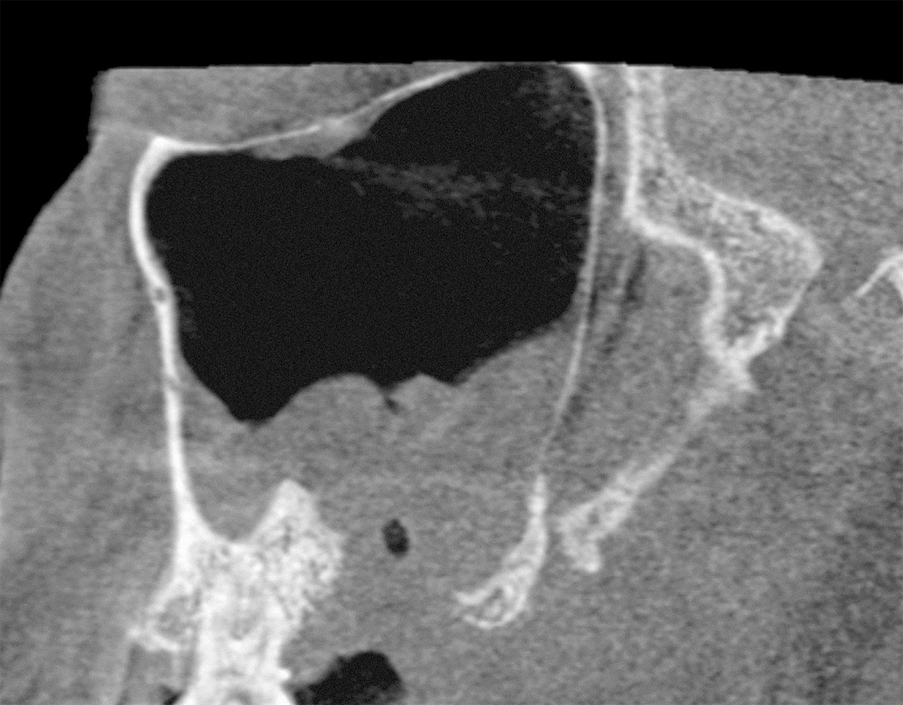 Abb. 25 60-jähriger Patient mit einer iatrogen verursachten Sinusitis in der linken Kieferhöhle nach einem zahnärztlich-chirurgischen Eingriff mit Entfernung der Zähne 27 und 28. Gut ist das Fehlen der ossären Abgrenzung zwischen Mund- und Kieferhöhle in diesem Bereich zu erkennen (sagittaler Schnitt; ...