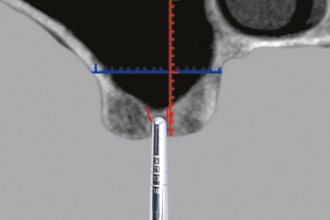 Abb. 13 Schematische Darstellung der Regio 16 im koro­nalen Schnittbild. Position des Osteotoms ca. 1,5 mm vor dem Sinusboden. Durch die Osteotomie entsteht eine Fraktur des kompakten Sinusbodens.