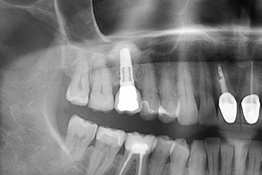 Abb. 18 Abschlussröntgenbild der Regio 16 nach Eingliederung des Zahnersatzes.