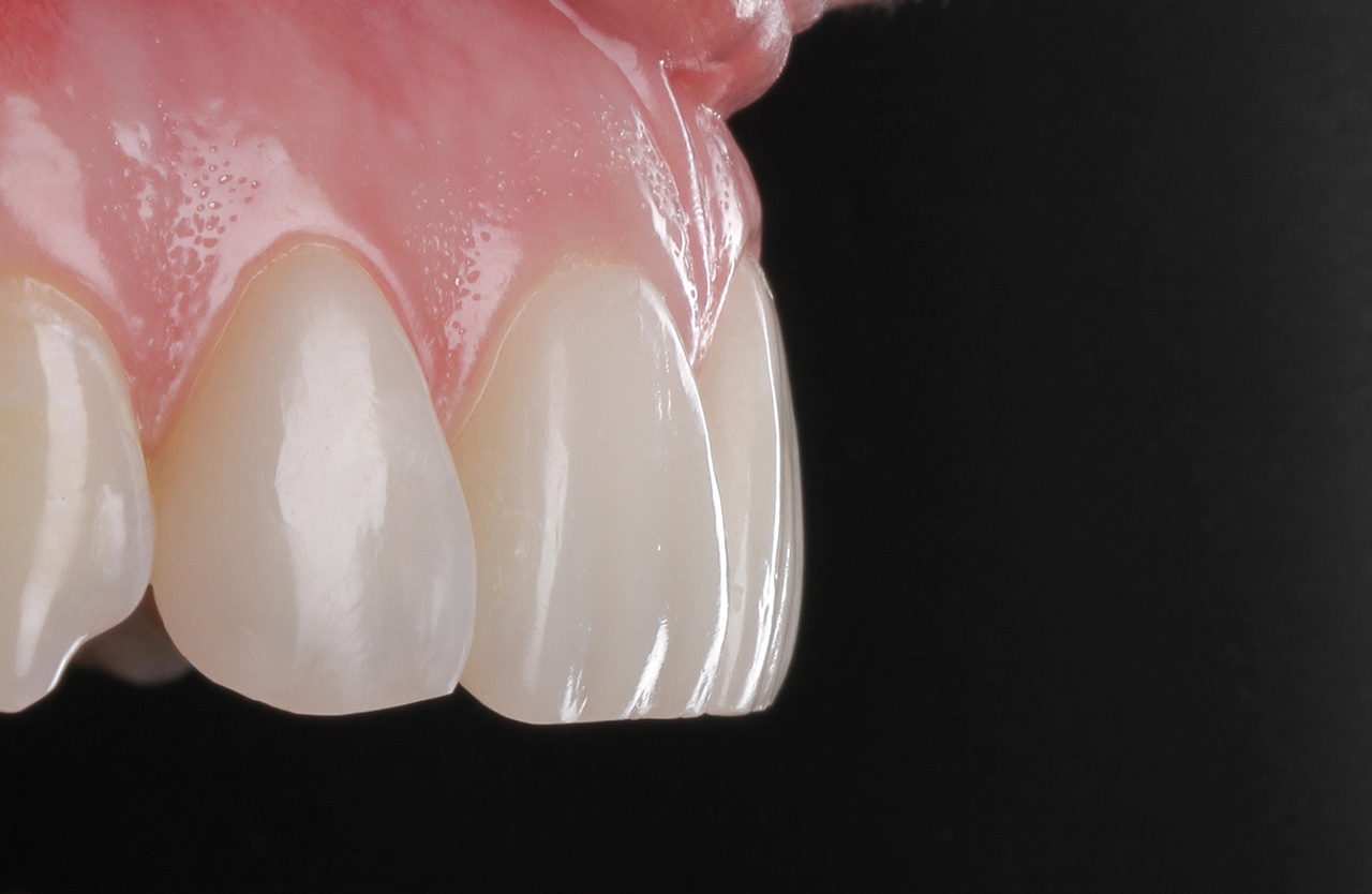 Abb. 11: Nahaufnahme der Veneer-Oberfläche, die zeigt, wie gut die natürliche Oberfläche der Zähne adaptiert wurde. (Foto: Kunkela)
