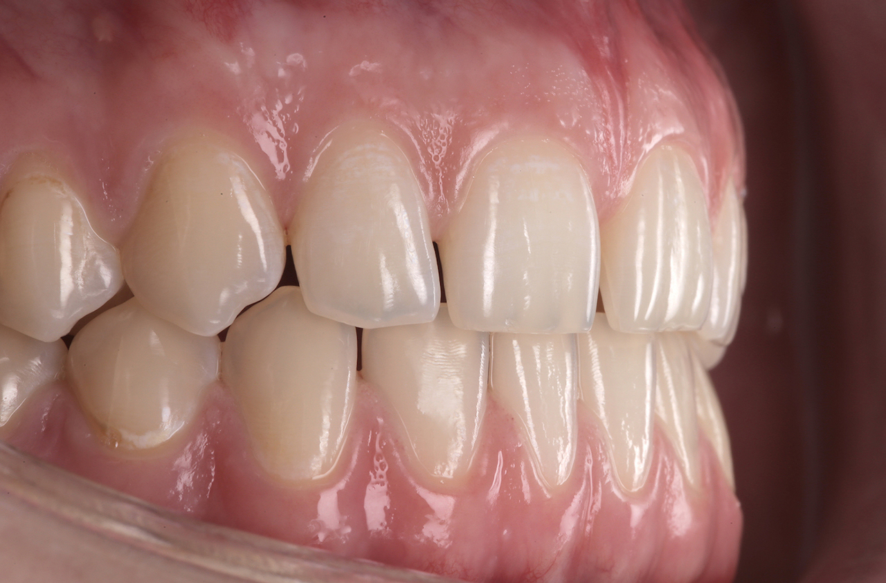 Abb. 2: Die natürliche Zahnstruktur, die wir für die finale Restauration adaptieren wollten. (Foto: Kunkela)