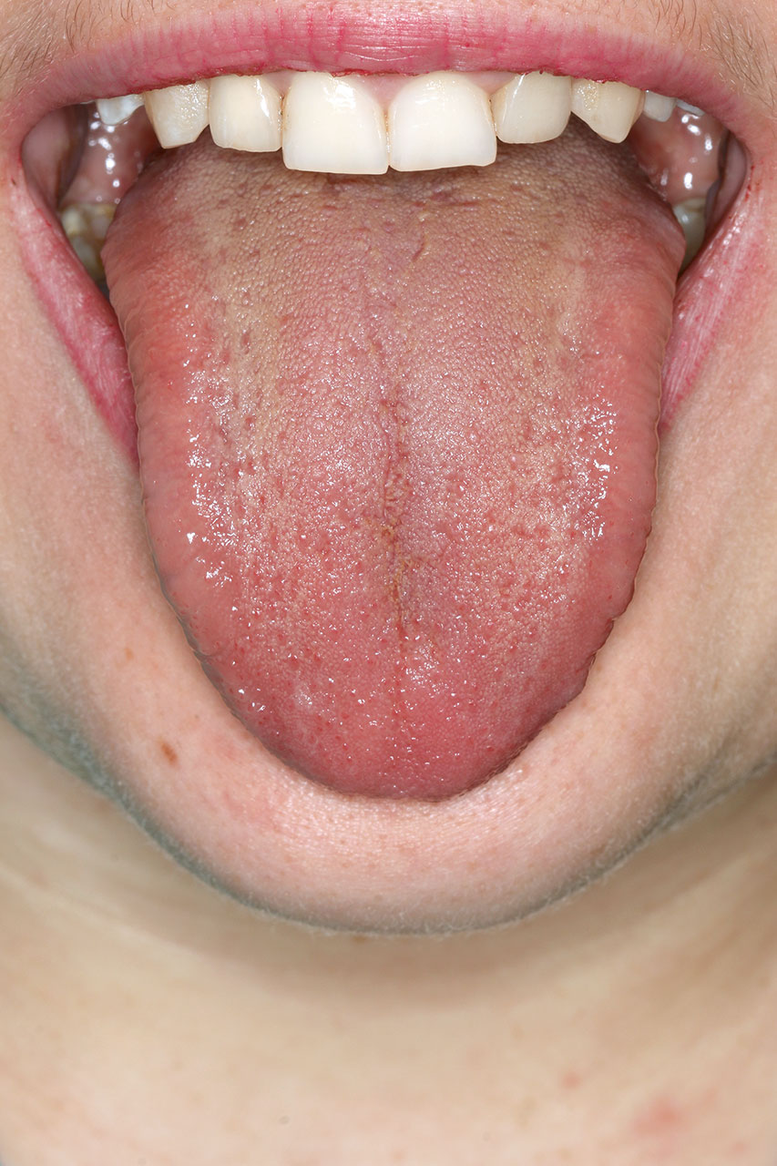 Abb. 2 bis 4 Ansicht des Zungen­rückens und der lateralen Zungenränder einer normalen Zunge mit leichtem Belag.