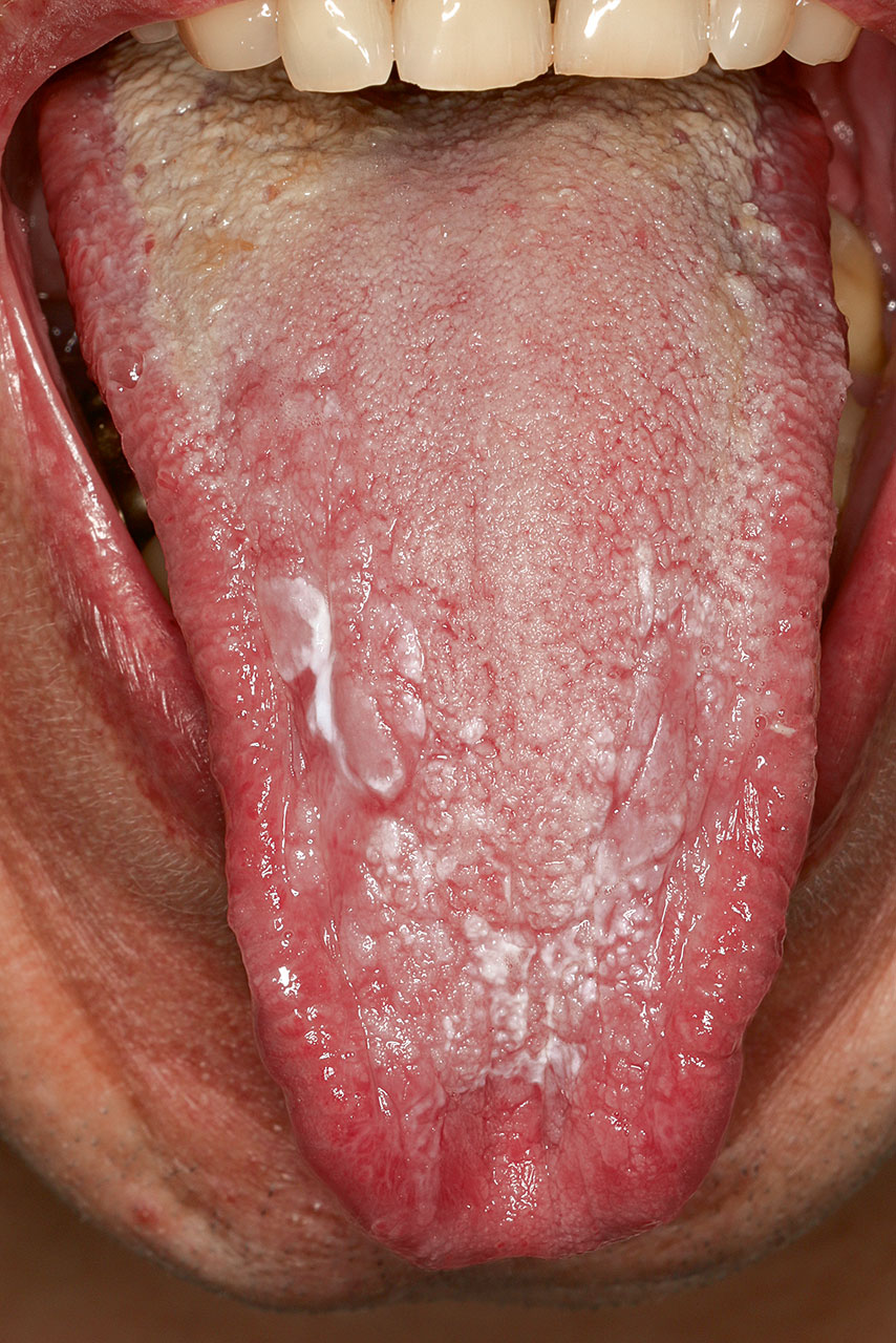 Abb. 2 Ausgeprägter Zungenbelag im hinteren Zungendrittel bei gleichzeitig vorliegender pseudomembranöser Candida-Infektion im mittleren und vorderen Zungendrittel.