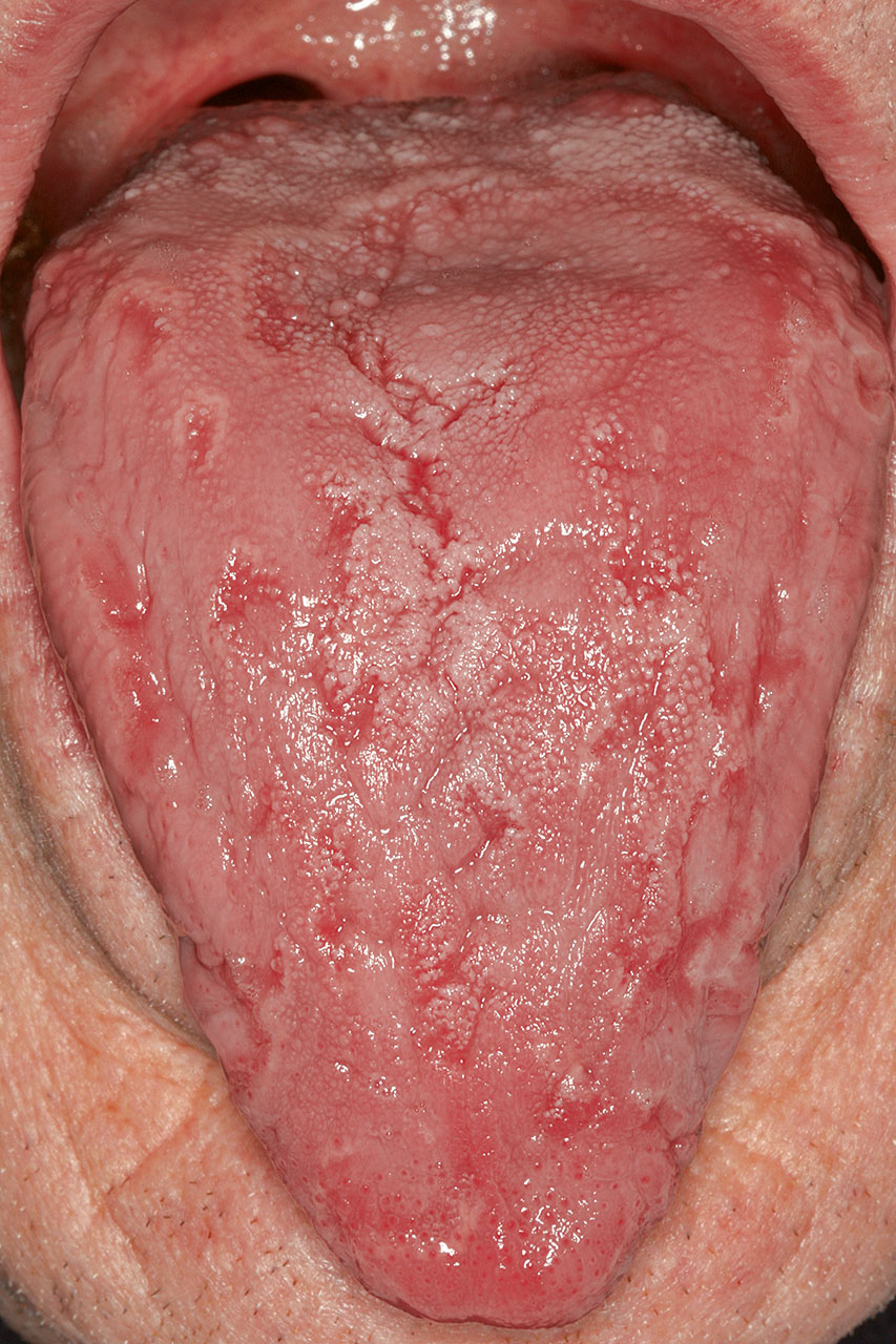 Abb. 4 Lingua geographica, die den gesamten Zungenrücken des Patienten betrifft.