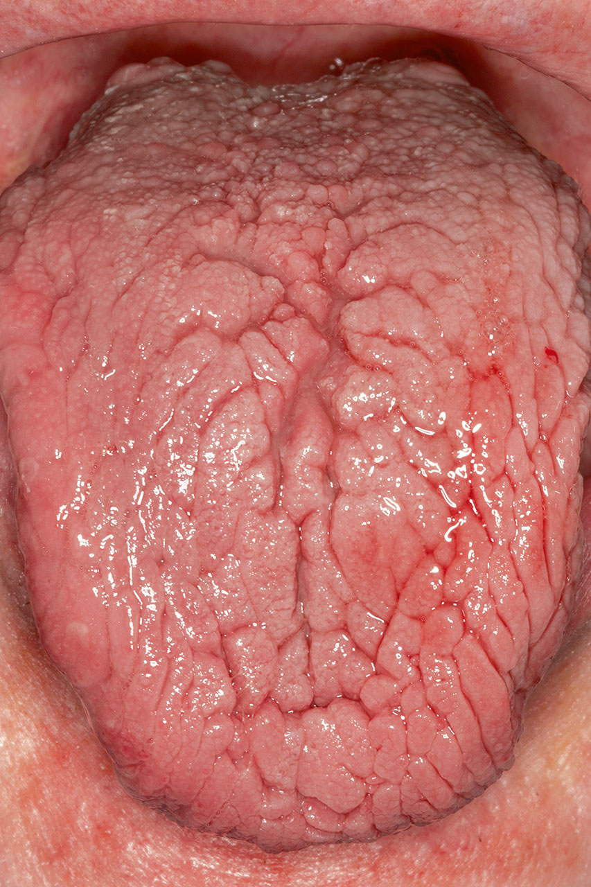 Abb. 5 Ausgeprägte Form einer Lingua plicata, die den gesamten Zungen­rücken des Patienten betrifft.