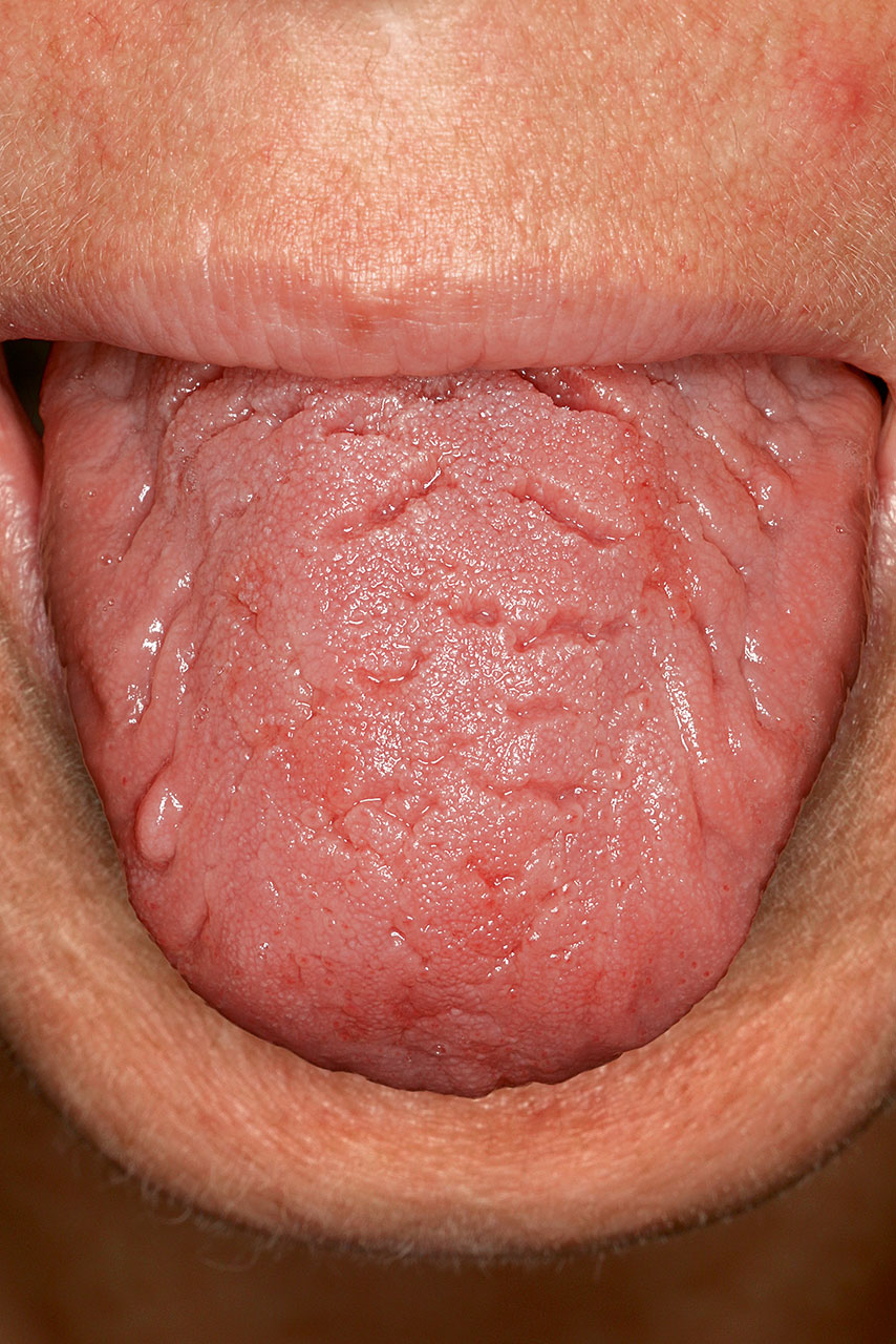 Abb. 6 Leichtere Form einer Lingua plicata mit einem kleinen Irritations­fibrom im Bereich des vorderen rechten Zungendrittels.