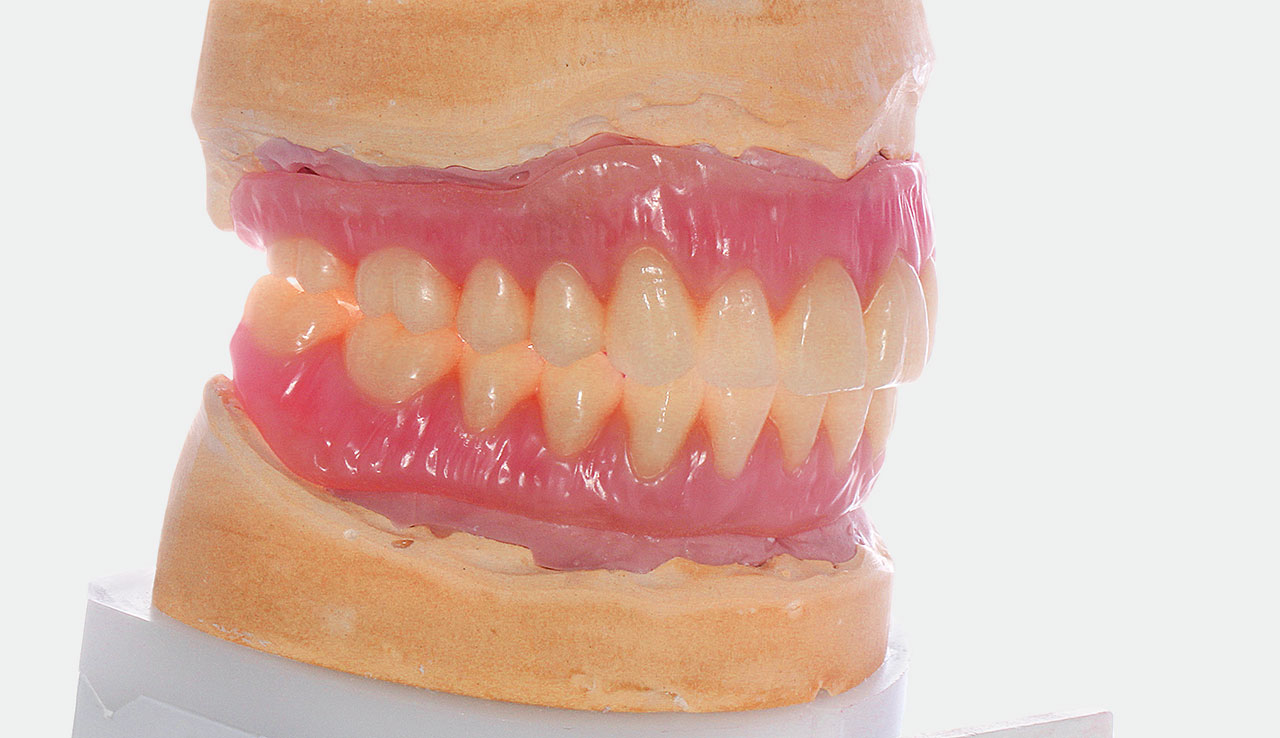 Abb. 9 Durch die leichte Verschachtelung wirken die Zähne natürlicher.
