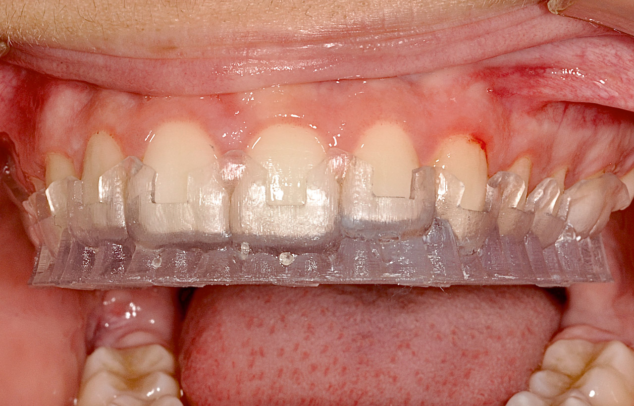 Abb. 40 bis 42 Mit der Positionierungsschiene wird dem Zahnarzt ein sinnvolles Hilfsmittel zum einfachen Verkleben der Brackets geboten.