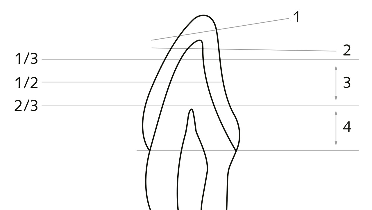 Abb. 1 Illustration der Einteilung des Zahnverschleißes gemäß Tabelle 2 (nach Wetselaar und Lobbezoo, gemäß verschiedener Veröffentlichungen der Amsterdamer Arbeitsgruppe).