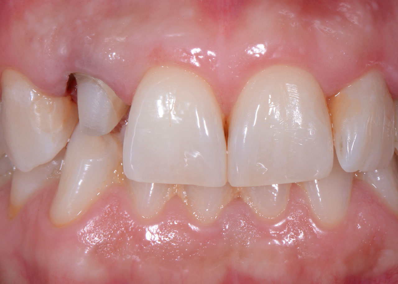 Abb. 8: Nach Fraktur des endodontisch vorbehandelten Zahns wird dieser für eine monolithische Vollkeramikkrone präpariert.