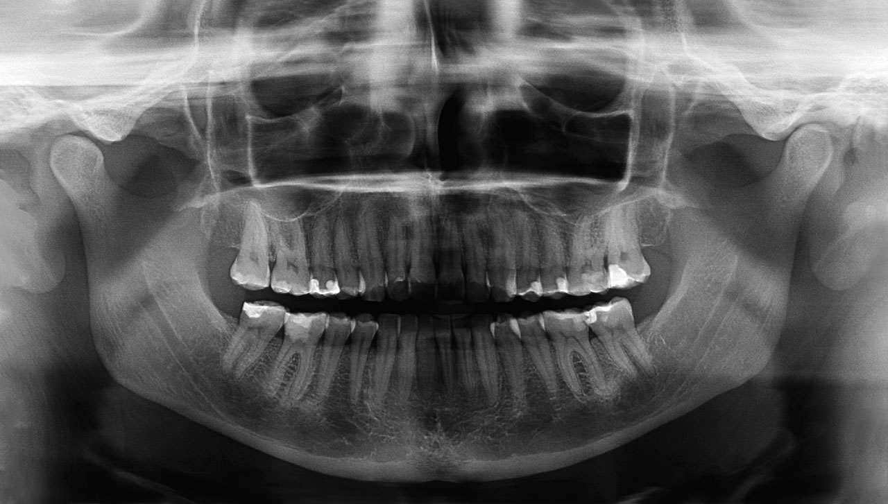 Abb. 7 Orthopanthomogramm zur Gesamtbehandlungsplanung und Verlaufskontrolle am Zahn 46 nach 3 Monaten.