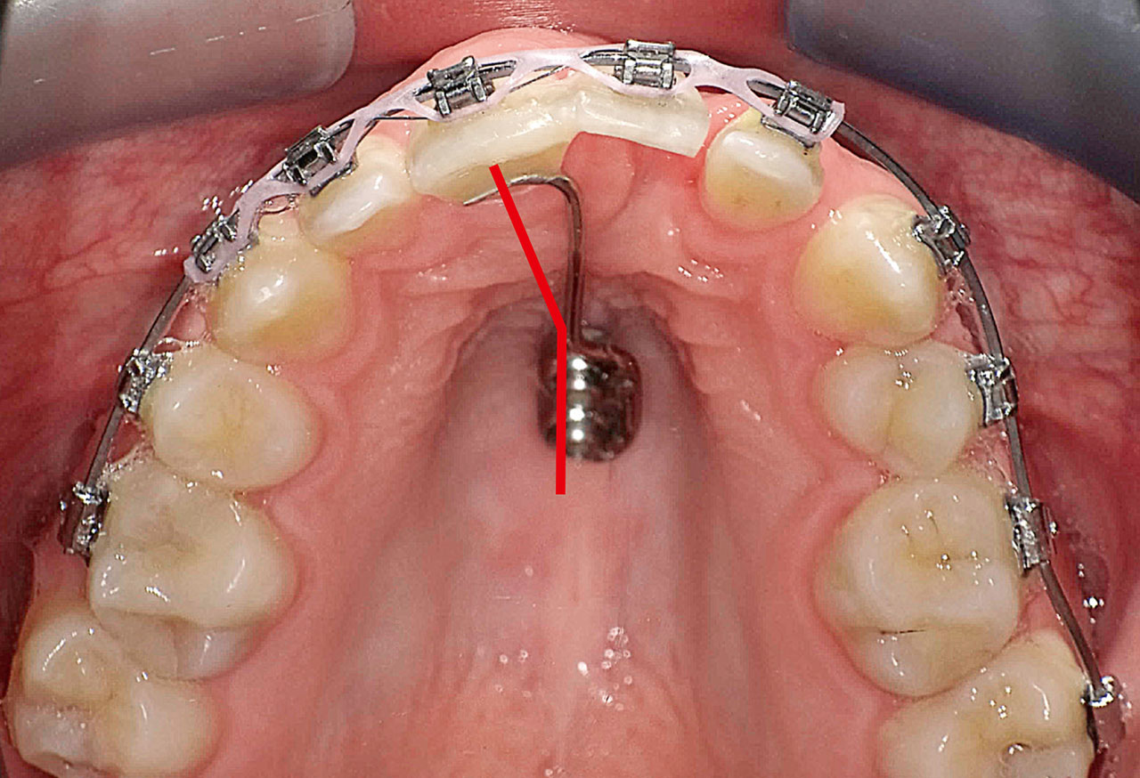 Abb. 4 Kieferorthopädische Verankerung für Lückenschlussmechanik (hier: Mesialisierung des Zahns 22 in Regio 21)