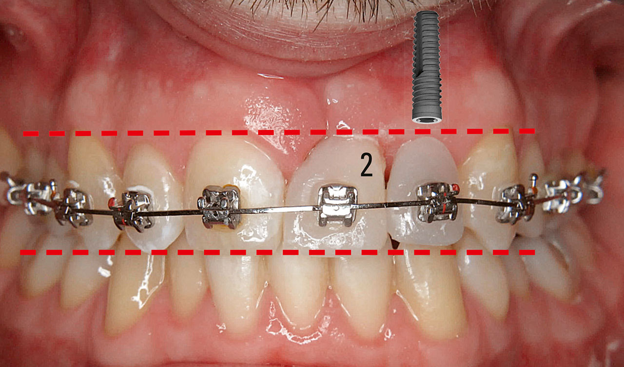 Abb. 7 Zustand nach kieferorthopädischer Mesialisierung des Zahns 22 in Regio 21 mit dem Ziel einer lokalen Knochenaugmentation.