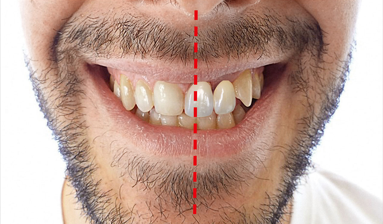 Abb. 8 Smile-Analyse, insbesondere der Mittenverhältnisse. Aufgrund einer nasalen Deviation nach links ist die dentale Oberkiefermitte in Relation zu weit nach rechts verschoben.