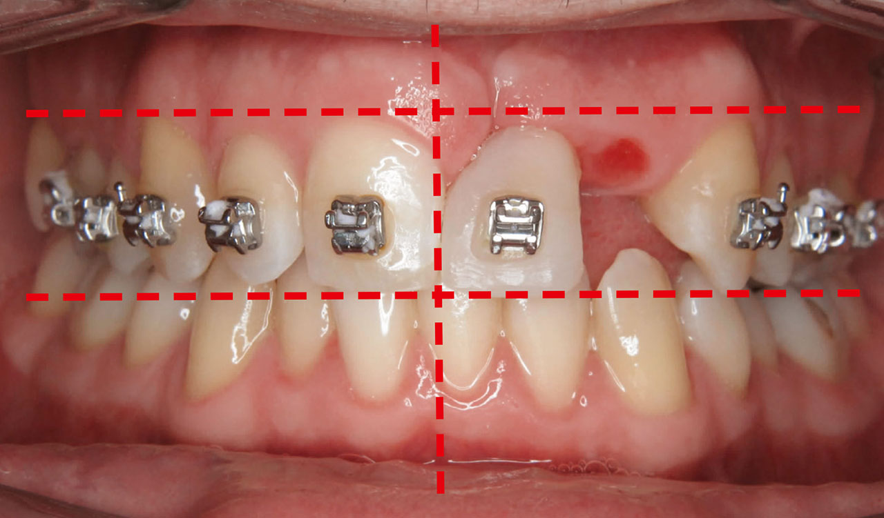 Abb. 9 Aufgrund eines asymmetrischen kieferorthopädischen Lückenschlusses in der Jugend ist die dentale Unterkiefermitte nach rechts verschoben.