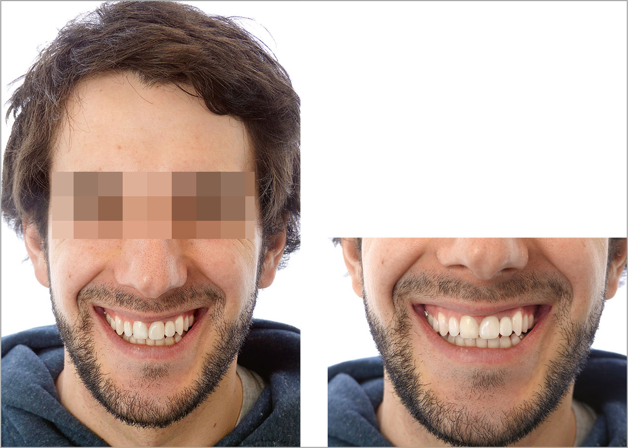 Abb. 16 Vergleich der extra- und intraoralen Situation nach biologischer Augmentation. Lachlinie, Gingivadisplay sowie Zahn- und Gesichtsmitte erscheinen natürlich.