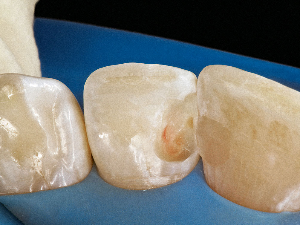 Abb. 4 Im Rahmen der Kariesexkavation unter absoluter Trockenlegung wurde die Zahnpulpa kleinflächig eröffnet. Es lagen weder pulpitische Symptome vor der Behandlung noch eine ausgeprägte Blutung vor.